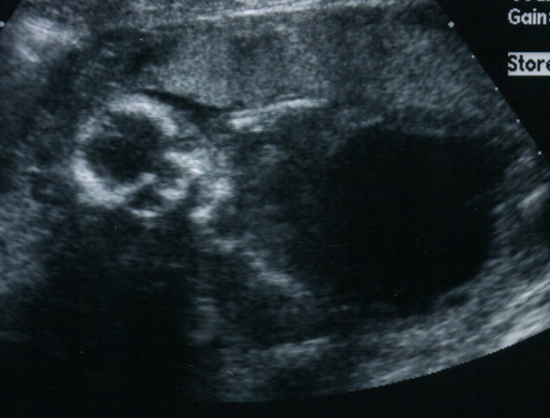 Ultrasound Picture